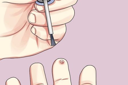 Удаление папиллом при помощи лекарств Удаление папиллом при помощи лекарств