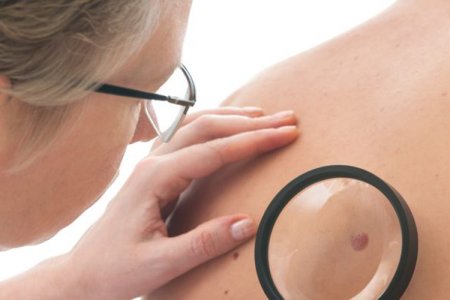 Обнаружение папиллом на коже Обнаружение папиллом на коже