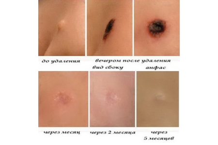 Процесс заживления папилломы после электрокоагуляции Процесс заживления папилломы после электрокоагуляции