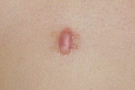 Рубец после удаления папилломы Рубец после удаления папилломы