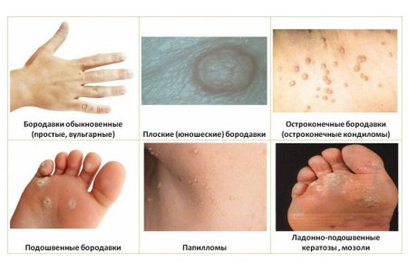 Варианты проявления ВПЧ Варианты проявления ВПЧ