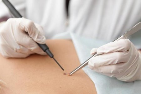 Удаление папиллом при помощи прижигания Удаление папиллом при помощи прижигания