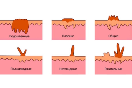Виды папиллом Виды папиллом