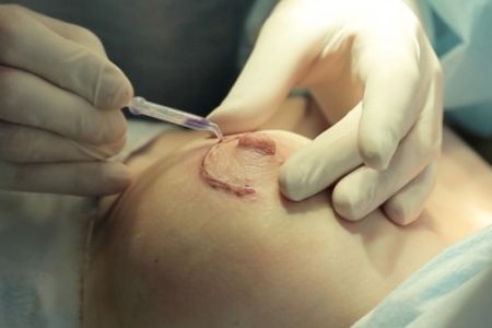 Хирургическое удаление папилломы на груди Хирургическое удаление папилломы на груди