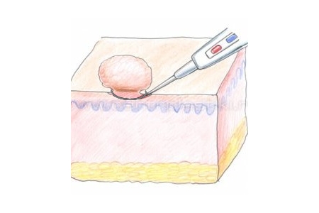 Удаление папилломы радиоволновым ножом Удаление папилломы радиоволновым ножом