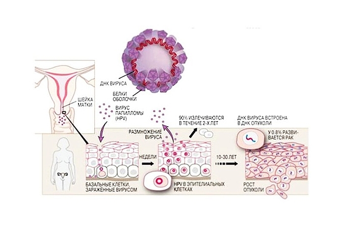 Схема развития вируса папилломы человека Схема развития вируса папилломы человека