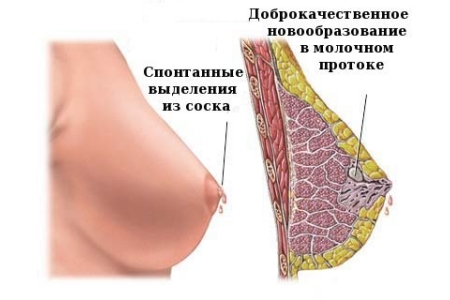 Внтурипотоковая папиллома молочных желез Внтурипотоковая папиллома молочных желез