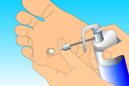 Удаление папиллом азотом Удаление папиллом азотом