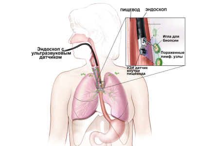 Биопсия пищевода Биопсия пищевода