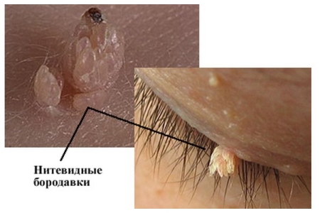 Частое появление акрохорд на лице Частое появление акрохорд на лице
