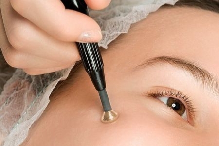 Удаление папилломы на лице Удаление папилломы на лице