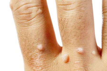 Появление бородавок при заражении ВПЧ Появление бородавок при заражении ВПЧ