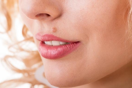 Образование папилломы над верхней губой Образование папилломы над верхней губой