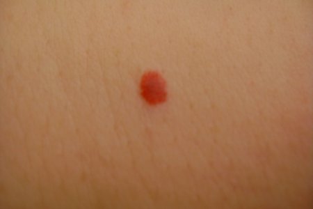 Проблема появления красных папиллом Проблема появления красных папиллом