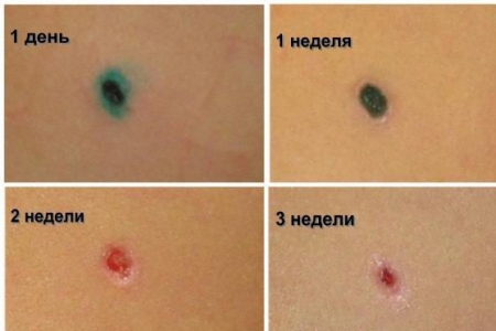 Заживание раны после удаления папилломы Заживание раны после удаления папилломы