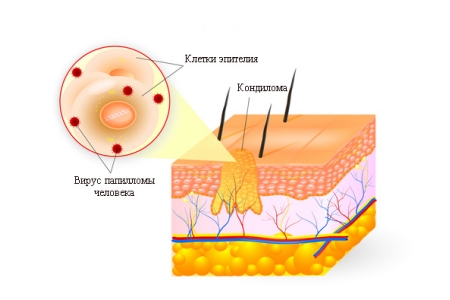 Образование кондиломы Образование кондиломы