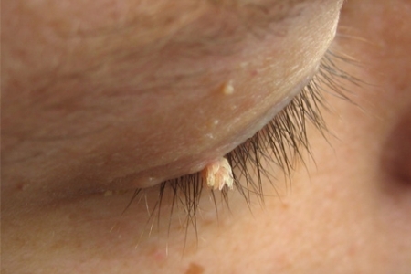Возникновение папилломы на веке Возникновение папилломы на веке