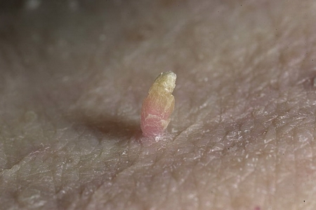 Обнаружение нитевидной папилломы на коже Обнаружение нитевидной папилломы на коже