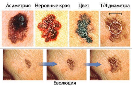 Признаки опасных родинок Признаки опасных родинок
