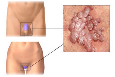 Появление папиллом в паху Появление папиллом в паху