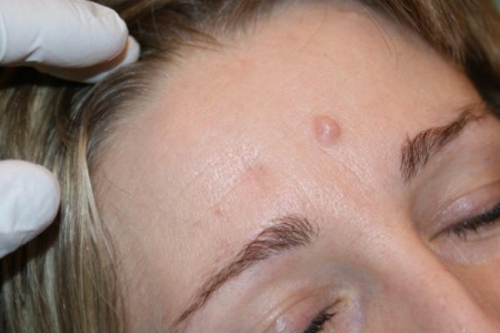 Проблема папилломы на лице Проблема папилломы на лице