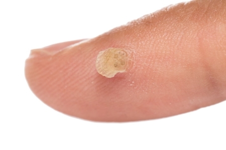 Появление папилломы Появление папилломы