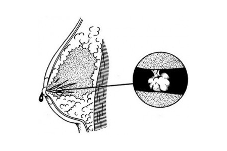 Схема папилломы на соске Схема папилломы на соске