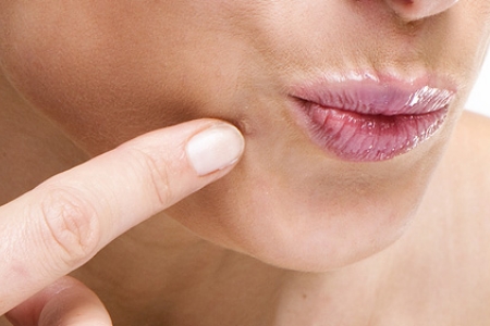 Избавление от папиллом Избавление от папиллом