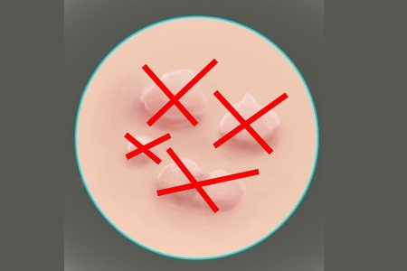 Удаление папиллом Удаление папиллом