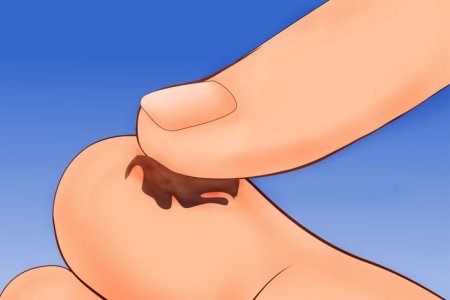 Опасность потемнения папиллом Опасность потемнения папиллом