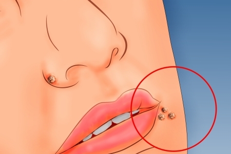 Проблема плоских папиллом Проблема плоских папиллом