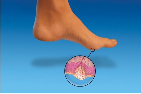 Проблема подошвенных бородавок Проблема подошвенных бородавок