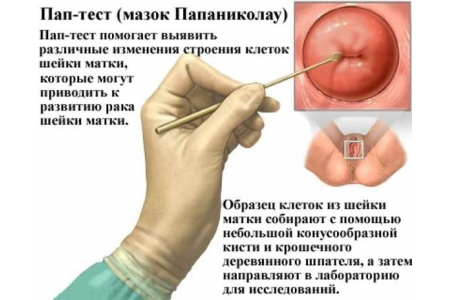 Проведение пап-теста Проведение пап-теста
