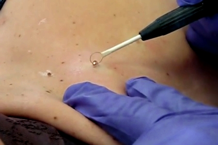 Удаление папиллом при помощи радиоволн Удаление папиллом при помощи радиоволн