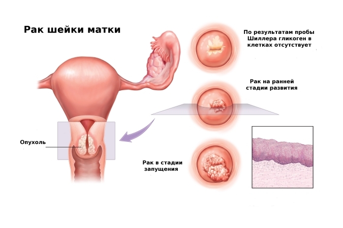 Рак шейки матки из-за вируса впч Рак шейки матки из-за вируса впч