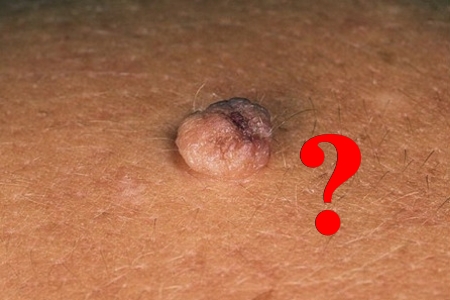 Определение родинки и папилломы Определение родинки и папилломы