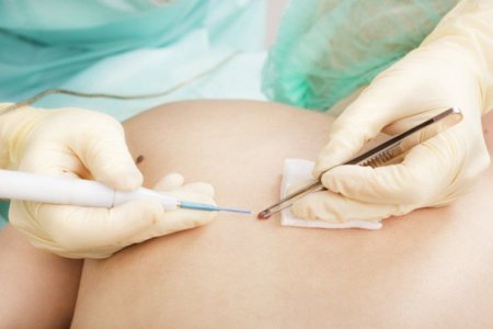 Удаление наростов Удаление наростов