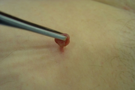 Самостоятельное удаление папилломы Самостоятельное удаление папилломы