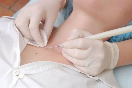 Необходимость ухода за ранками после удаления папиллом Необходимость ухода за ранками после удаления папиллом