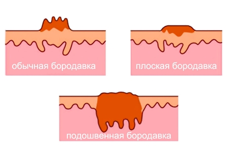 Виды бородавок Виды бородавок