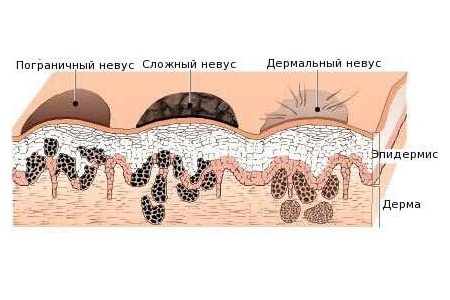 Виды родинок Виды родинок