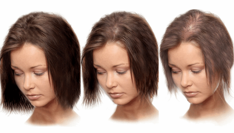 Симптомы и варианты лечения облысения