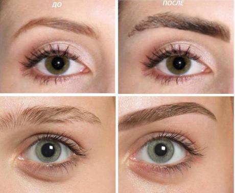 Реабилитация после пересадки бровей