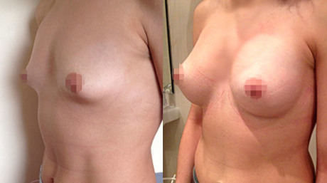 1396551583_uvelichenie_grudi_foto_do_i_posle_25