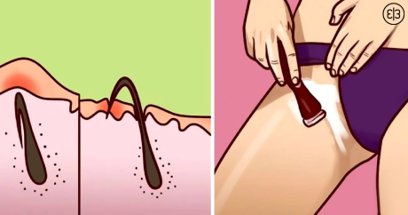 Способ избавления от волосяного врастания