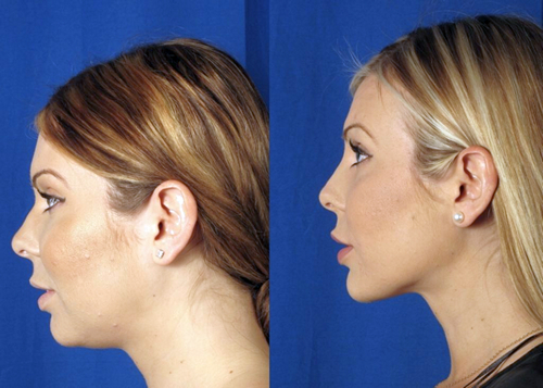 липосакции в зоне подбородка