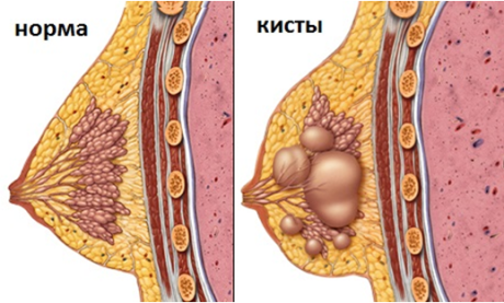 гипертрофии молочных желез методы лечения