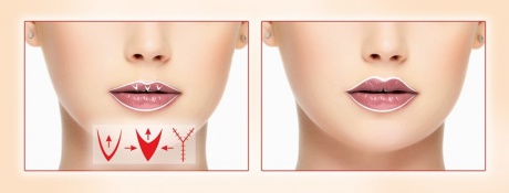 Пластика губ