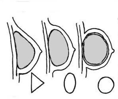 капсулярная контрактура