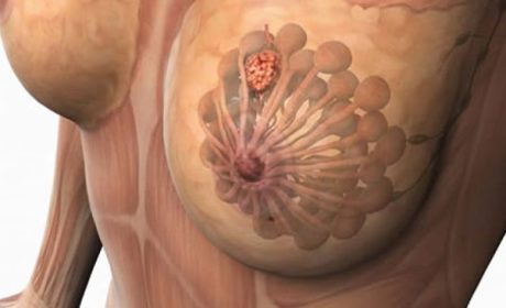 Гипертрофия молочных желез: разновидности и методы лечения